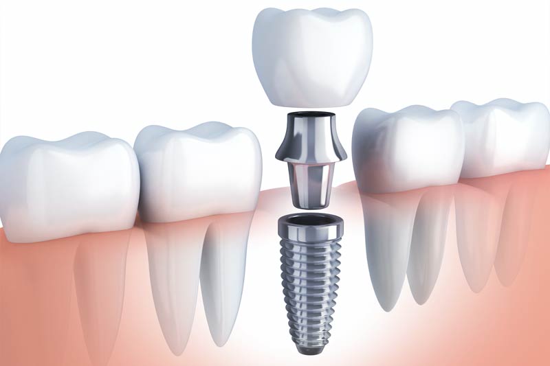 Implants Dentist in South Gate